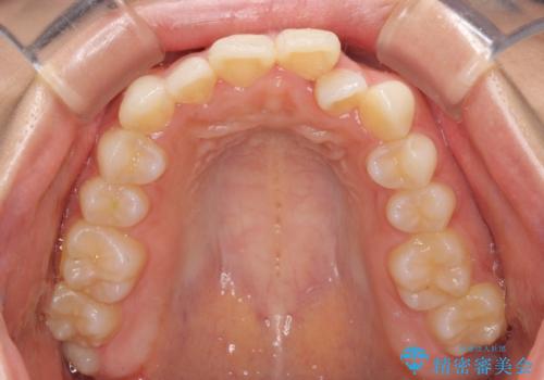 【モニター】前歯のクロスバイトをインビザラインで治療の治療前