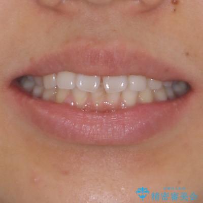 隙間の空いた前歯を閉じたい　インビザライン矯正の治療前（顔貌）
