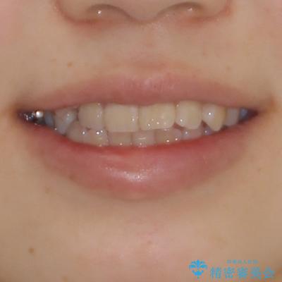 閉じにくい口元と八重歯　ワイヤー装置での抜歯矯正の治療前（顔貌）