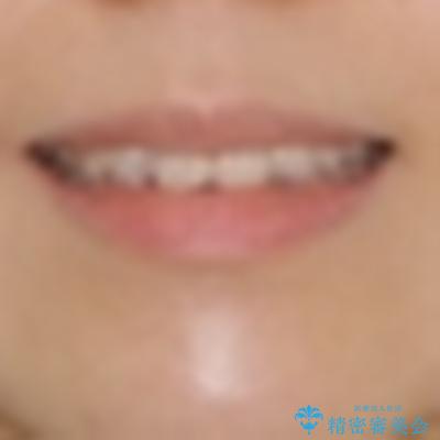 上下前歯の前歯と腫れやすい歯肉 インビザライン矯正で改善の治療前(顔貌)