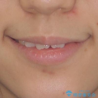 目立つ八重歯を治したい インビザラインによる矯正治療の治療前(顔貌)