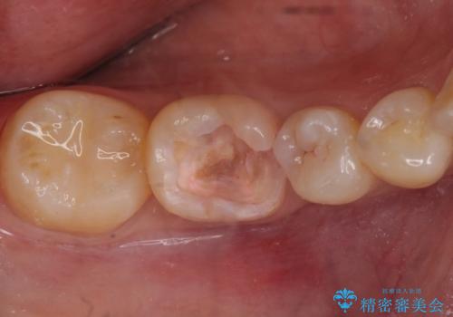 欠けた詰め物 セラミッククラウンでの修復の治療中