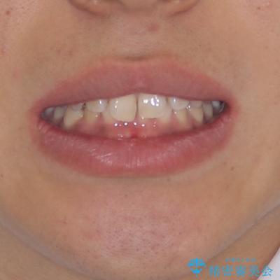 デコボコとディープバイトを治したい インビザラインによる矯正治療の治療前(顔貌)