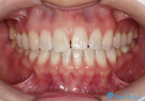 【インビザラインで再矯正】マウスピース矯正で隙間を閉じたいの治療前