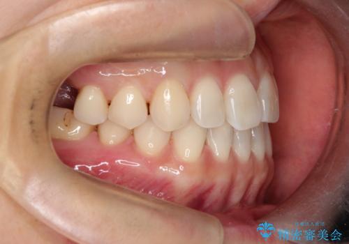 【インビザラインで再矯正】マウスピース矯正で隙間を閉じたいの治療前