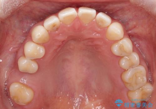【インビザラインで再矯正】マウスピース矯正で隙間を閉じたいの治療前