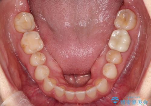 【インビザラインで再矯正】マウスピース矯正で隙間を閉じたいの治療前