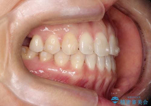 【インビザラインで再矯正】マウスピース矯正で隙間を閉じたいの治療中