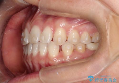 【インビザラインで再矯正】マウスピース矯正で隙間を閉じたいの治療中