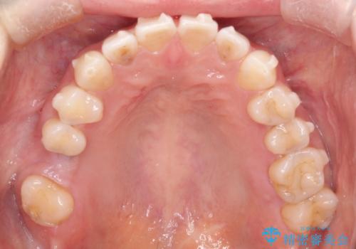 【インビザラインで再矯正】マウスピース矯正で隙間を閉じたいの治療中