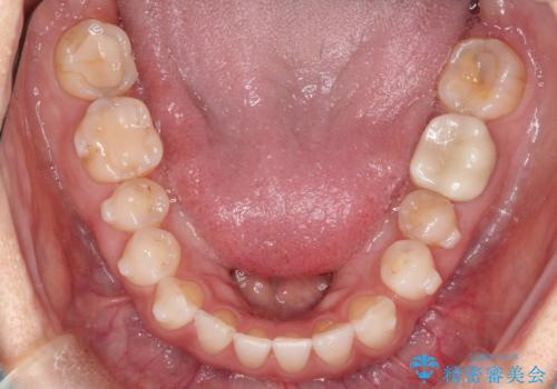 【インビザラインで再矯正】マウスピース矯正で隙間を閉じたいの治療中