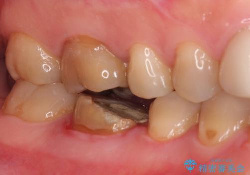 【精密根管治療】間違った根管形成→パフォレーションリペアによる修復 の治療前