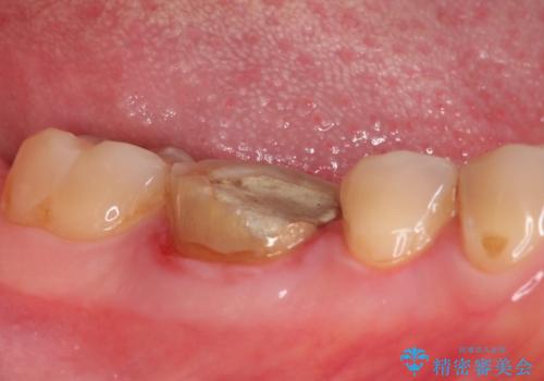 【精密根管治療】間違った根管形成→パフォレーションリペアによる修復 の治療前