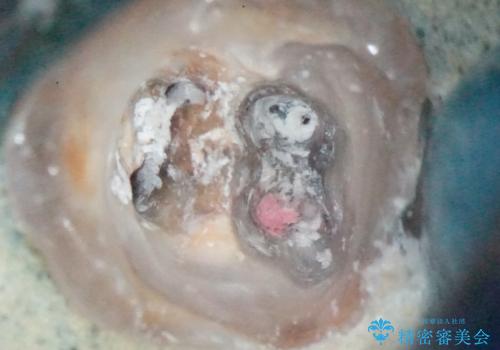 【精密根管治療】間違った根管形成→パフォレーションリペアによる修復 の治療中