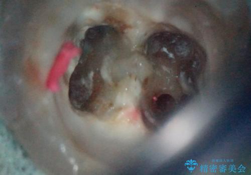 【精密根管治療】間違った根管形成→パフォレーションリペアによる修復 の治療中