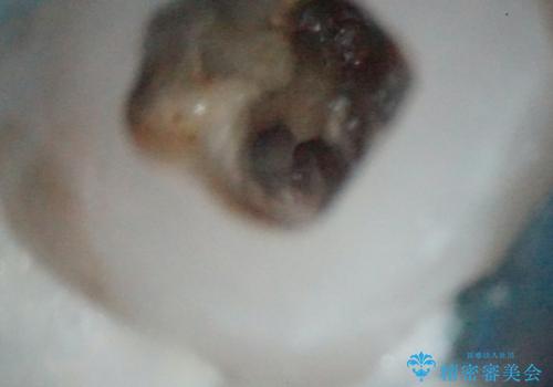 【精密根管治療】間違った根管形成→パフォレーションリペアによる修復 の治療中