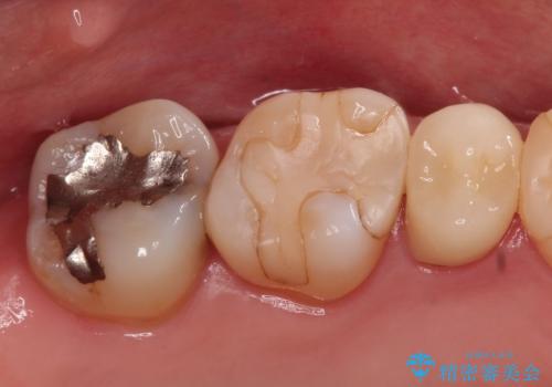 【セラミックインレー】虫歯の治療の治療前