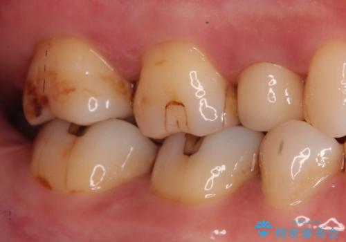 【セラミックインレー】虫歯の治療の治療前