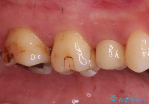 【セラミックインレー】虫歯の治療の治療前