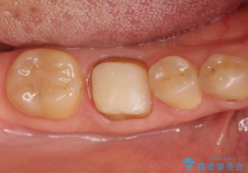 【精密根管治療】間違った根管形成→パフォレーションリペアによる修復 の治療中