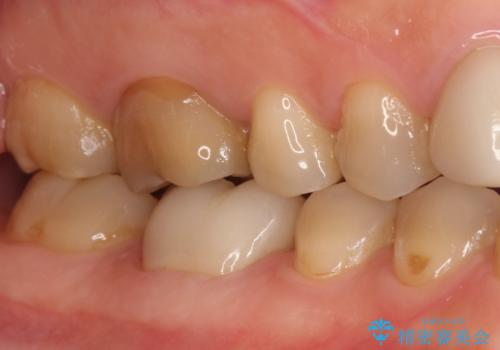 【精密根管治療】間違った根管形成→パフォレーションリペアによる修復 の治療後