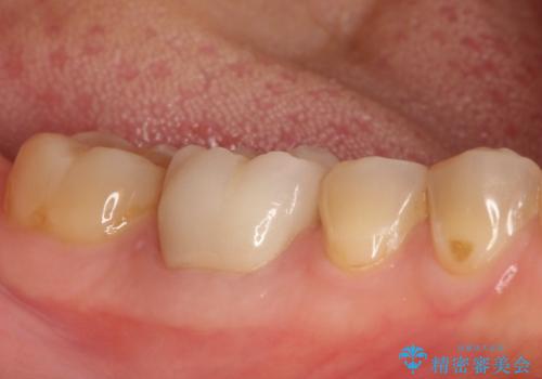 【精密根管治療】間違った根管形成→パフォレーションリペアによる修復 の治療後