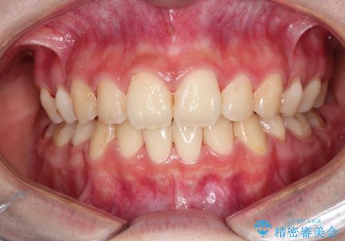 【ハーフリンガル】口元を下げたい!の治療後