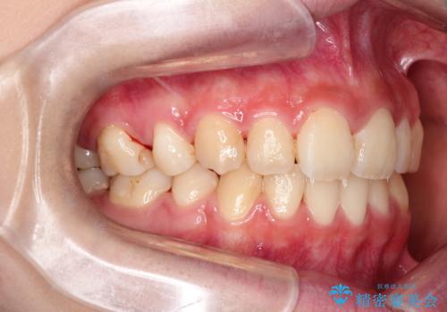 【ハーフリンガル】口元を下げたい!の治療後