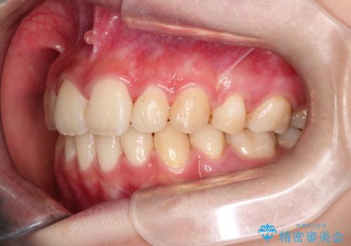 【ハーフリンガル】口元を下げたい!の治療後