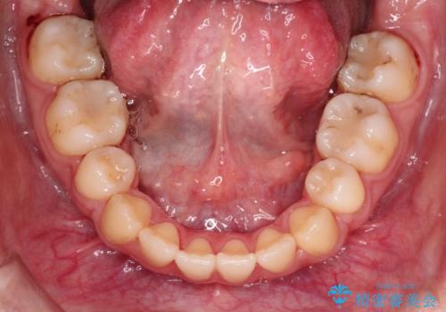 【ハーフリンガル】口元を下げたい!の治療後