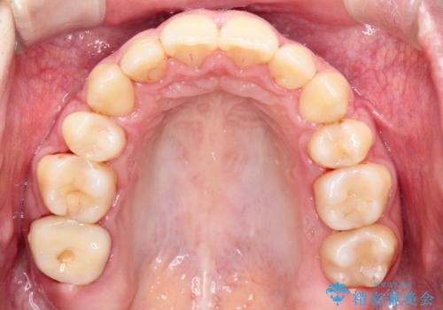 【ハーフリンガル】口元を下げたい!の治療後