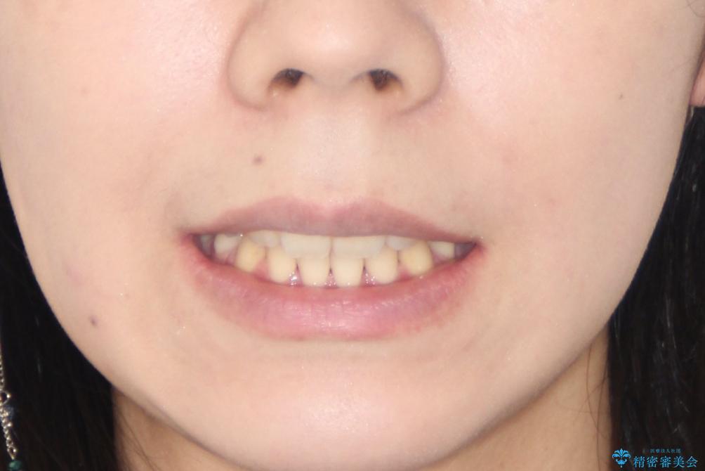 【ハーフリンガル】口元を下げたい!の治療後(顔貌)