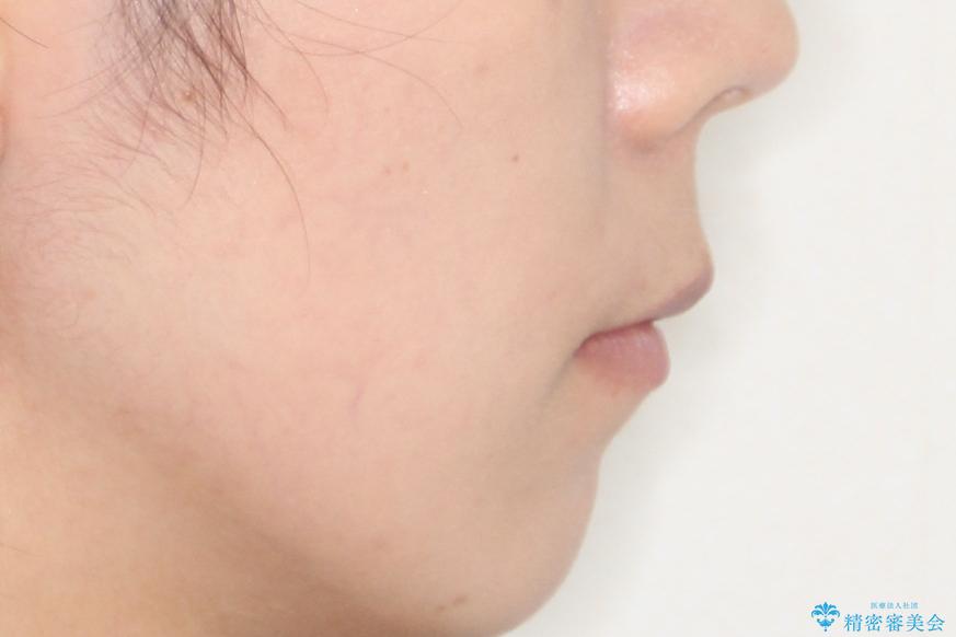 【ハーフリンガル】口元を下げたい!の治療後(顔貌)