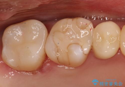 【セラミックインレー】虫歯の治療の治療後