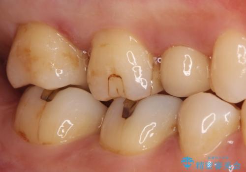 【セラミックインレー】虫歯の治療の治療後