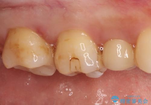 【セラミックインレー】虫歯の治療の治療後