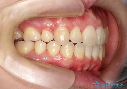 【難症例 インビザライン】抜歯+遠心移動ケースの治療後