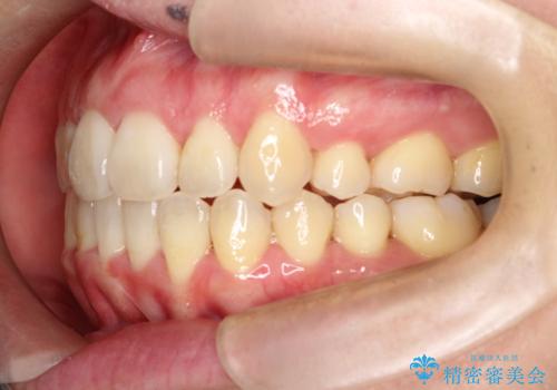 【難症例 インビザライン】抜歯+遠心移動ケースの治療後