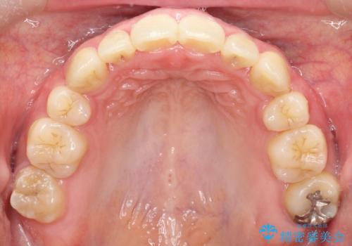 【難症例 インビザライン】抜歯+遠心移動ケースの治療後