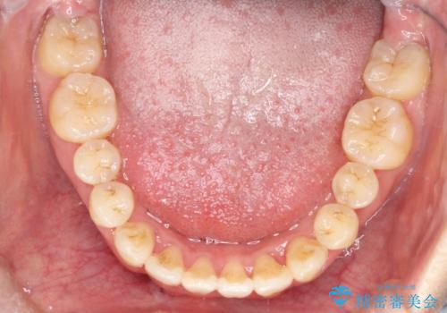 【難症例 インビザライン】抜歯+遠心移動ケースの治療後