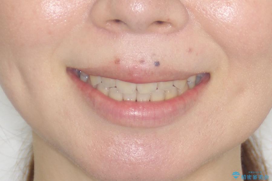 【難症例 インビザライン】抜歯+遠心移動ケースの治療後(顔貌)