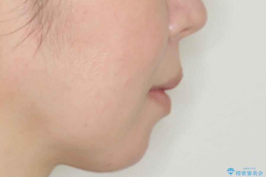 【難症例 インビザライン】抜歯+遠心移動ケースの治療後(顔貌)