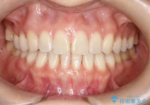 【インビザラインで再矯正】マウスピース矯正で隙間を閉じたいの治療後