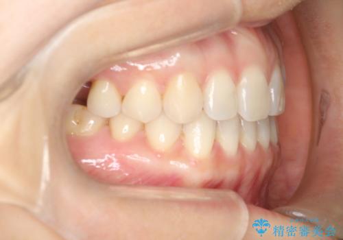 【インビザラインで再矯正】マウスピース矯正で隙間を閉じたいの治療後