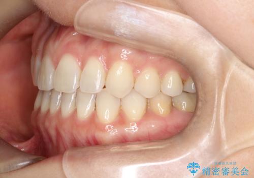 【インビザラインで再矯正】マウスピース矯正で隙間を閉じたいの治療後
