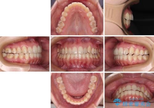 狭い歯列を拡大 拡大装置を併用したインビザライン矯正の治療後