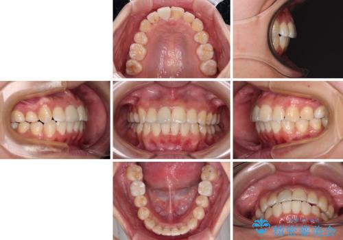 虫歯と抜いたままの奥歯とデコボコの前歯 総合歯科治療の治療後