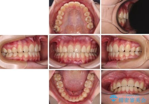 目立つ八重歯を治したい インビザラインによる矯正治療の治療後