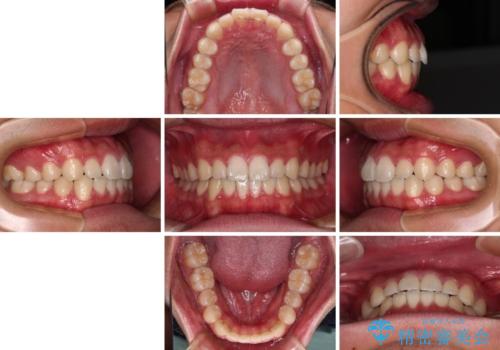 軽微叢生をインビザラインで 廉価版パッケージでの矯正治療の治療後