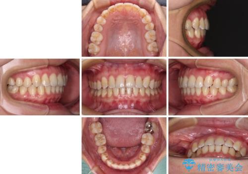 前歯の反対咬合 急速拡大装置とワイヤー装置であっという間の矯正治療の治療後